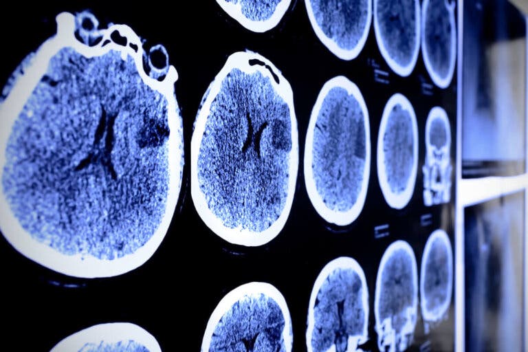 ¿Qué es un astrocitoma y cómo se puede tratar?