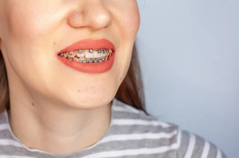 ¿Para qué se usan bandas elásticas en el tratamiento con brackets?