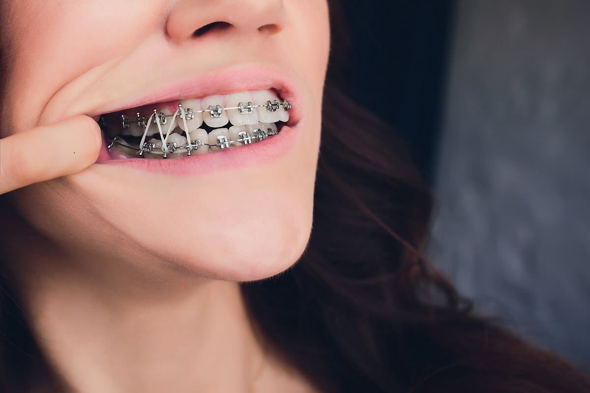 Mantenimiento de los brackets y las bandas elásticas