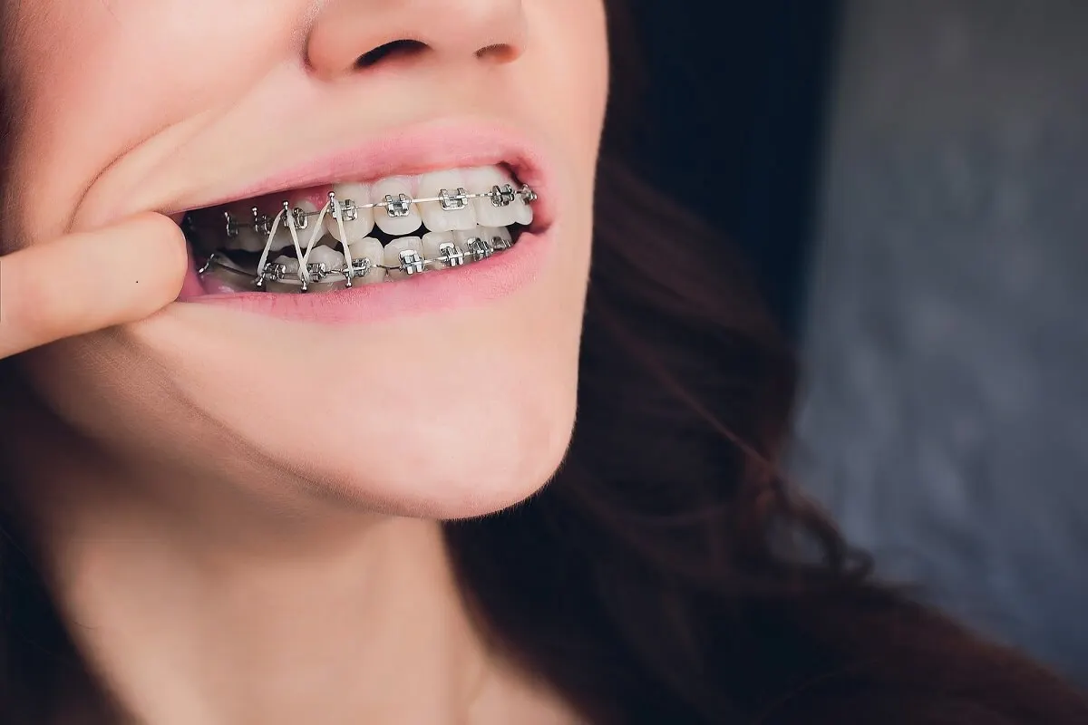 Mantenimiento de los brackets y las bandas elásticas