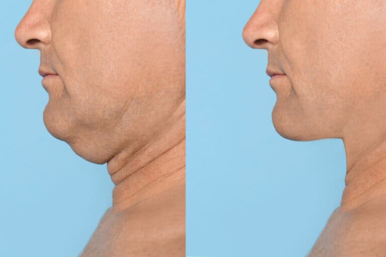 5 ejercicios para tener una mandíbula definida