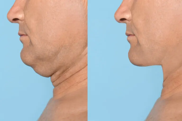 5 ejercicios para tener una mandíbula definida