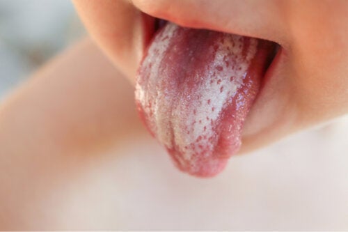 Muguet o candidiasis oral en bebés: síntomas y tratamientos