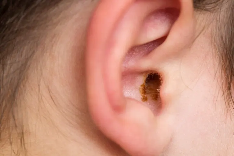 Oclusión por cerumen: ¿qué es y por qué ocurre?