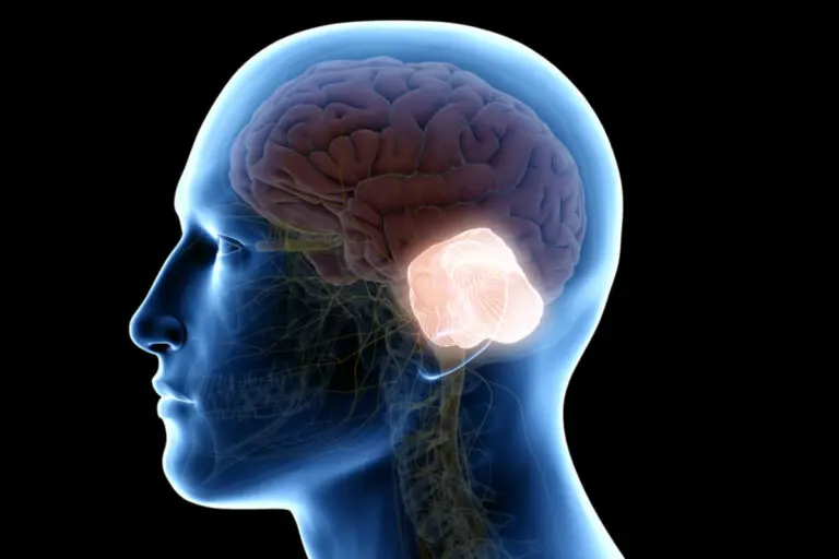 Malformación de Chiari: ¿qué es y por qué ocurre?