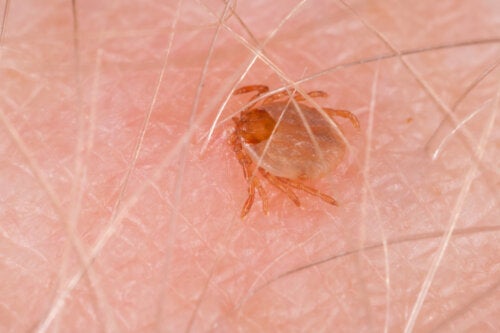 Fiebre maculosa de las montañas rocosas: síntomas y tratamientos