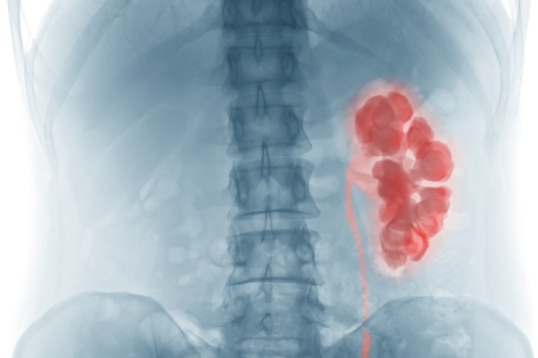 ¿Qué es la hidronefrosis y cuál es su tratamiento?