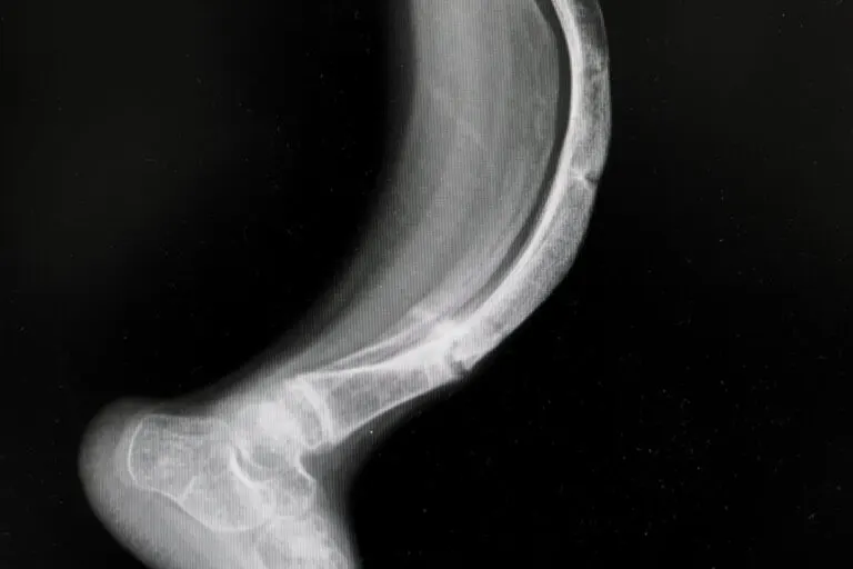 Día Internacional de la Osteogénesis Imperfecta: espíritu inquebrantable