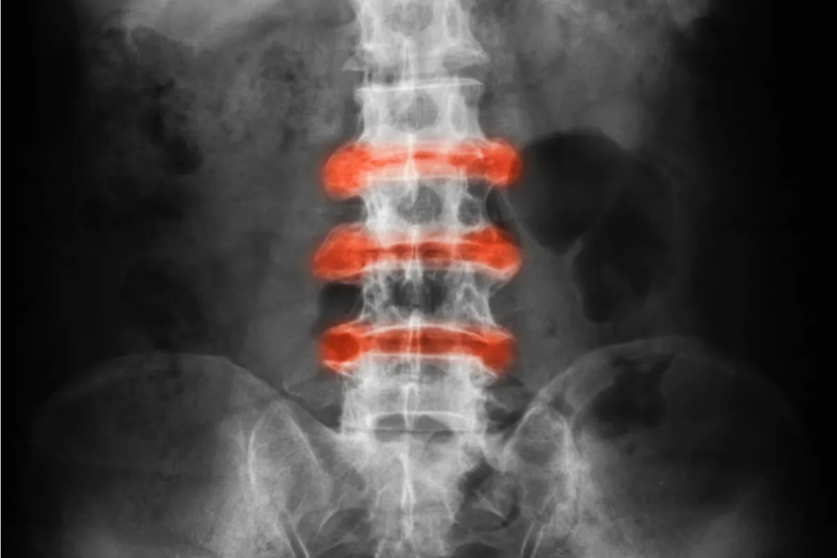 Espondiloartritis juvenil: espondiloartropatía en menores de 16 años de edad.