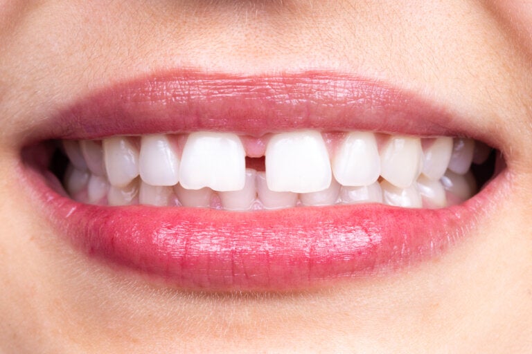 Diastema dental: ¿en qué consiste?