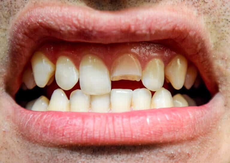 Traumatismo dental: ¿qué es y qué tipos existen?