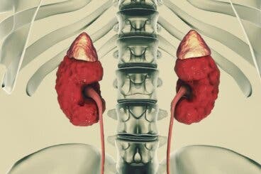 ¿Qué es la enfermedad renal poliquística? Síntomas y tratamiento