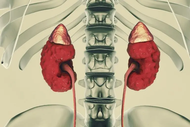 ¿Qué es la enfermedad renal poliquística? Síntomas y tratamiento