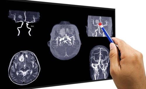 ¿Cómo se realiza la reparación de un aneurisma cerebral?