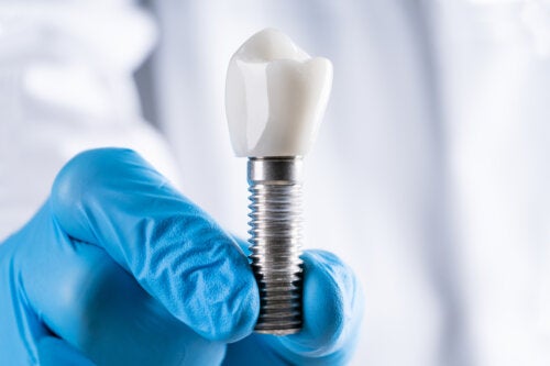 Periimplantitis: causas, síntomas y prevención