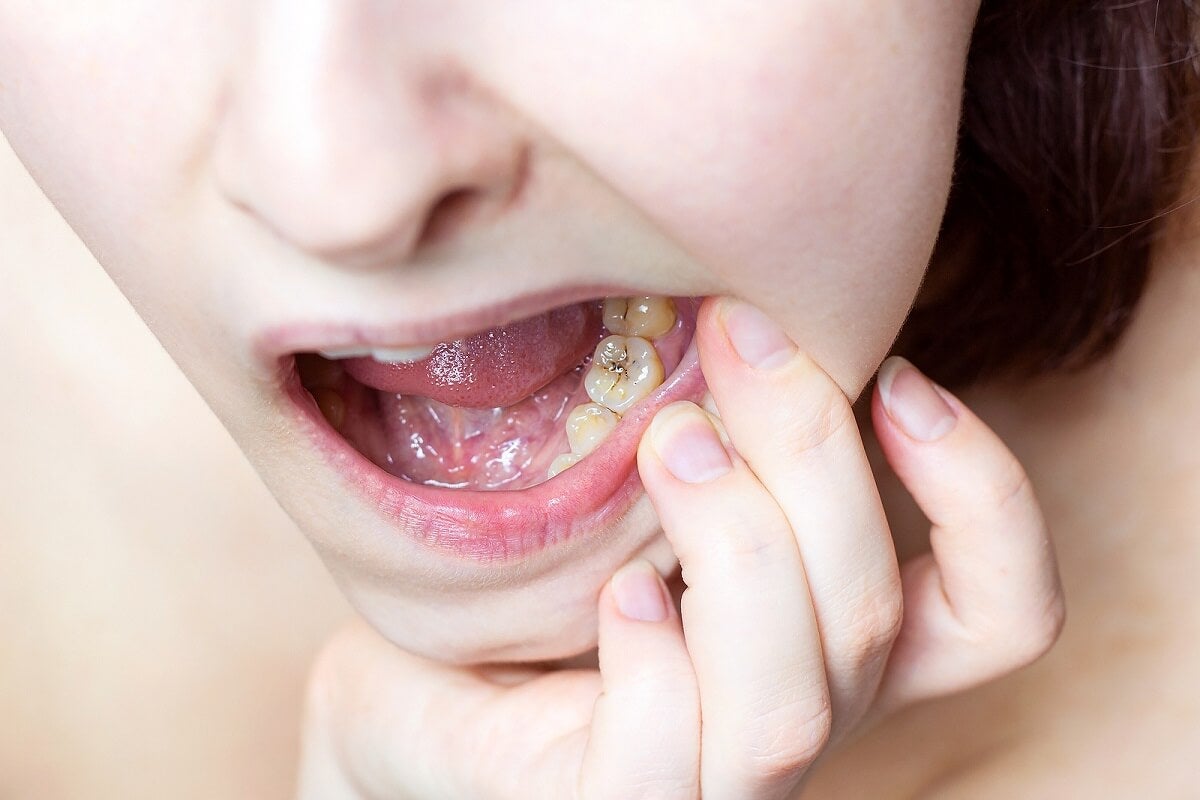 Проблеми със зъбите при тийнейджърите.