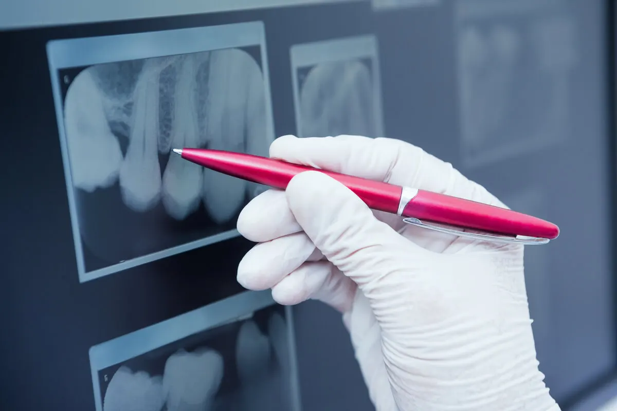 Impacto de la radiación de las radiografías dentales