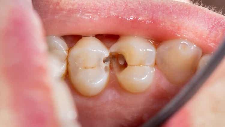 Muela picada: causas y tratamientos - Mejor con Salud
