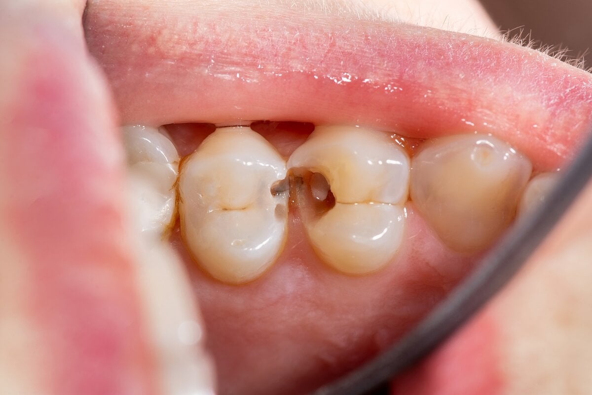 Carie dentaria per il mancato utilizzo di sigillanti dentali.