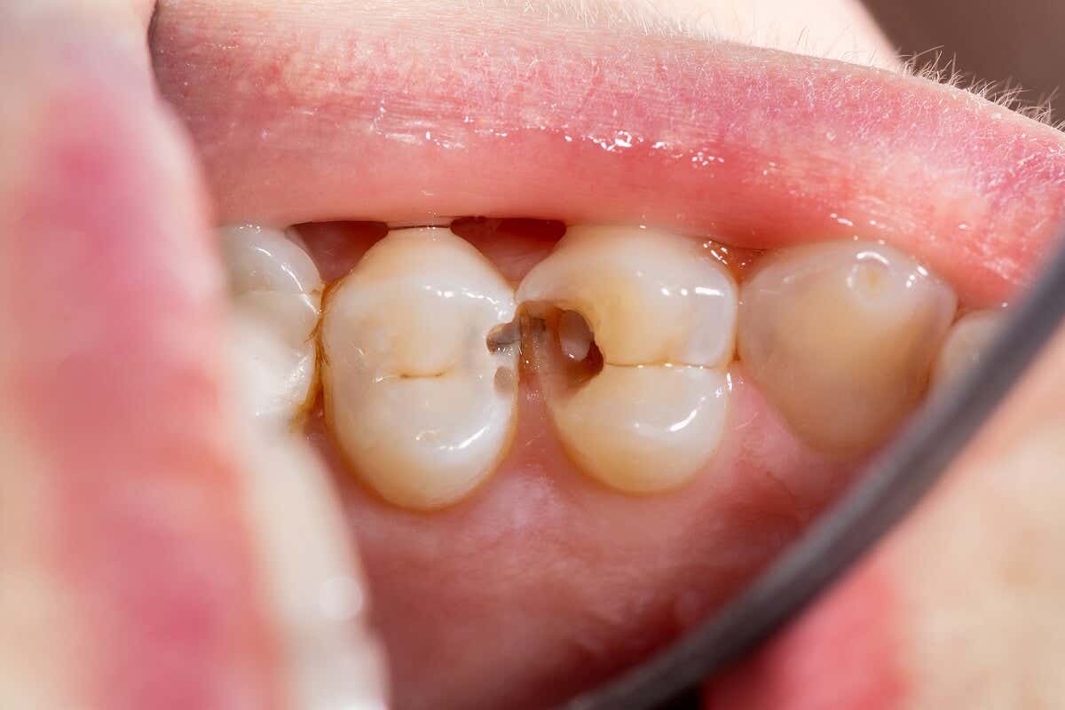 Tooth decay is one of the common oral diseases.
