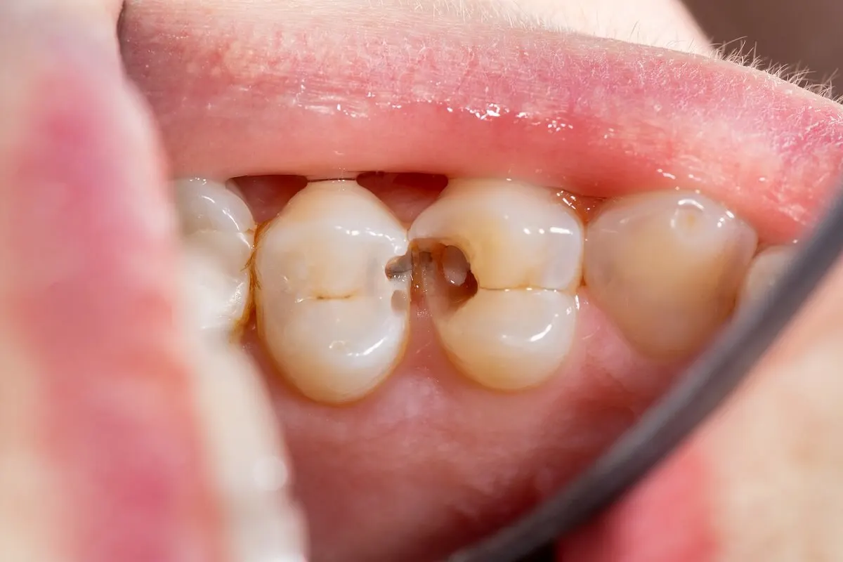 Caries.
