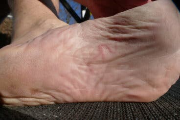 Picadura de nigua: prevención y tratamientos