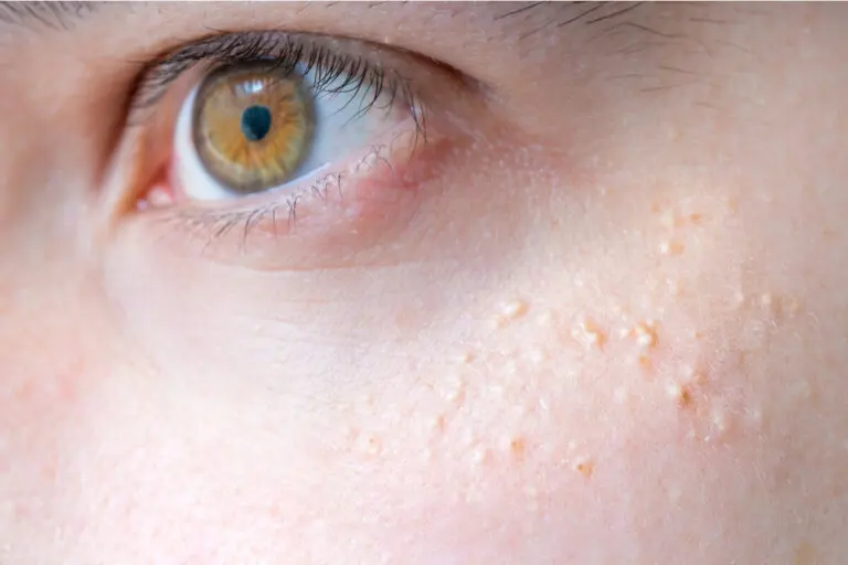 Quistes blancos en la cara: ¿a qué se deben y cómo tratarlos?