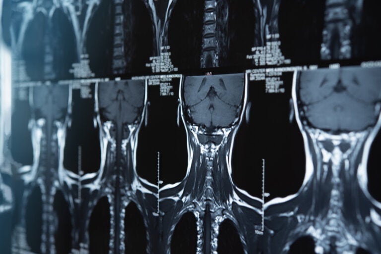 ¿Qué es un meduloblastoma y cómo se puede tratar?