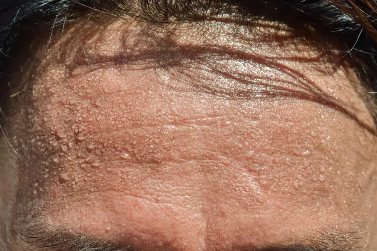 5 consejos para evitar el exceso de sudor en la cabeza