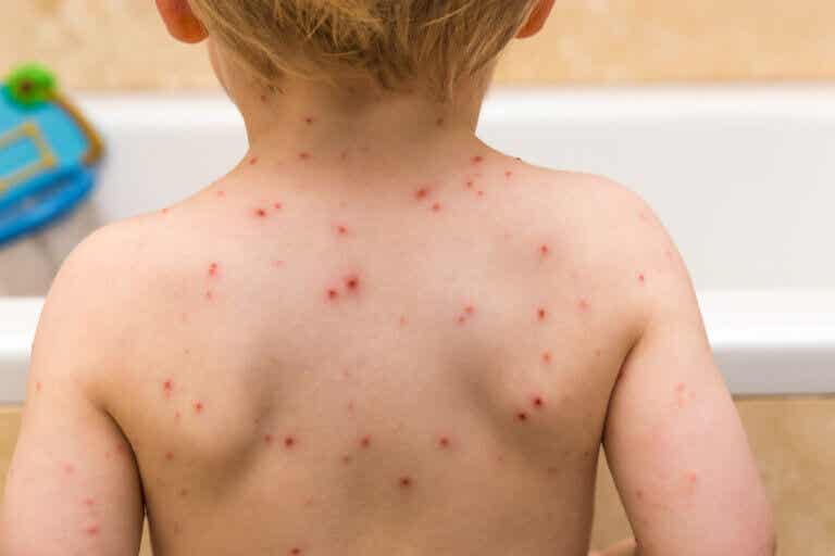 Fiesta de varicela o vacunación: ¿cuál es mejor opción?