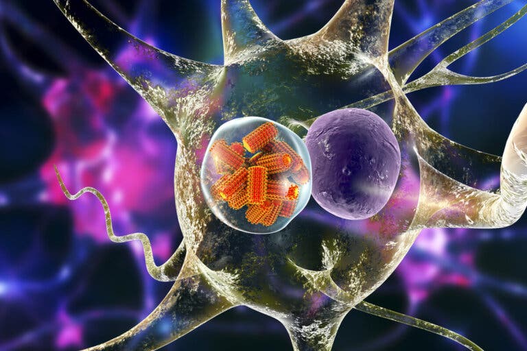 Leucoencefalopatía multifocal progresiva: todo lo que debes saber
