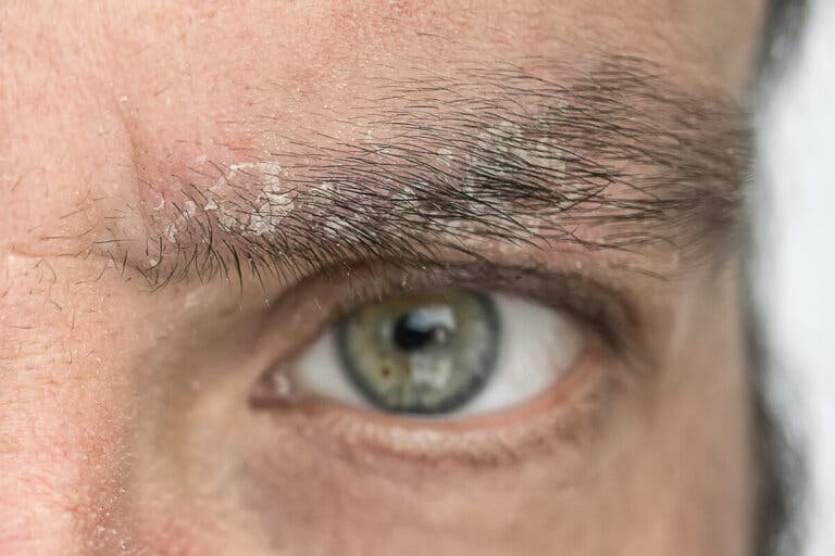 Caspa en las cejas: ¿por qué ocurre y cómo eliminarla?