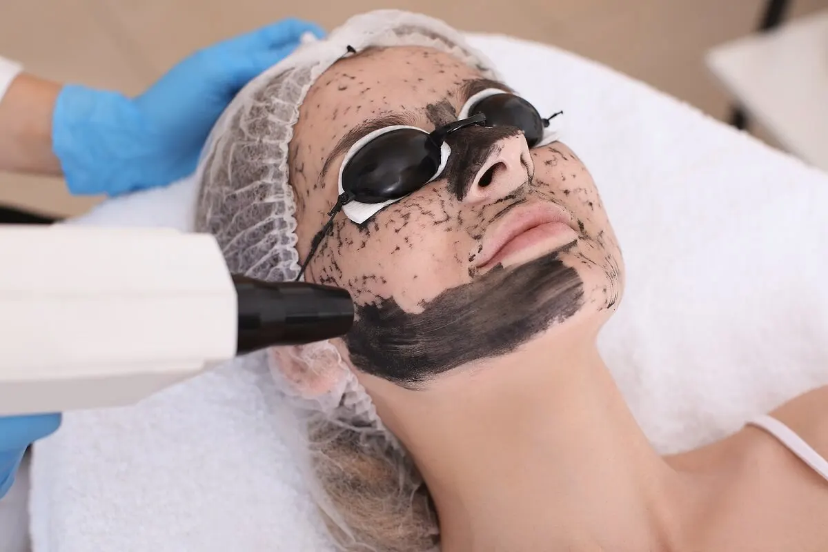 ¿La exfoliación láser con carbón activado provoca efectos secundarios?