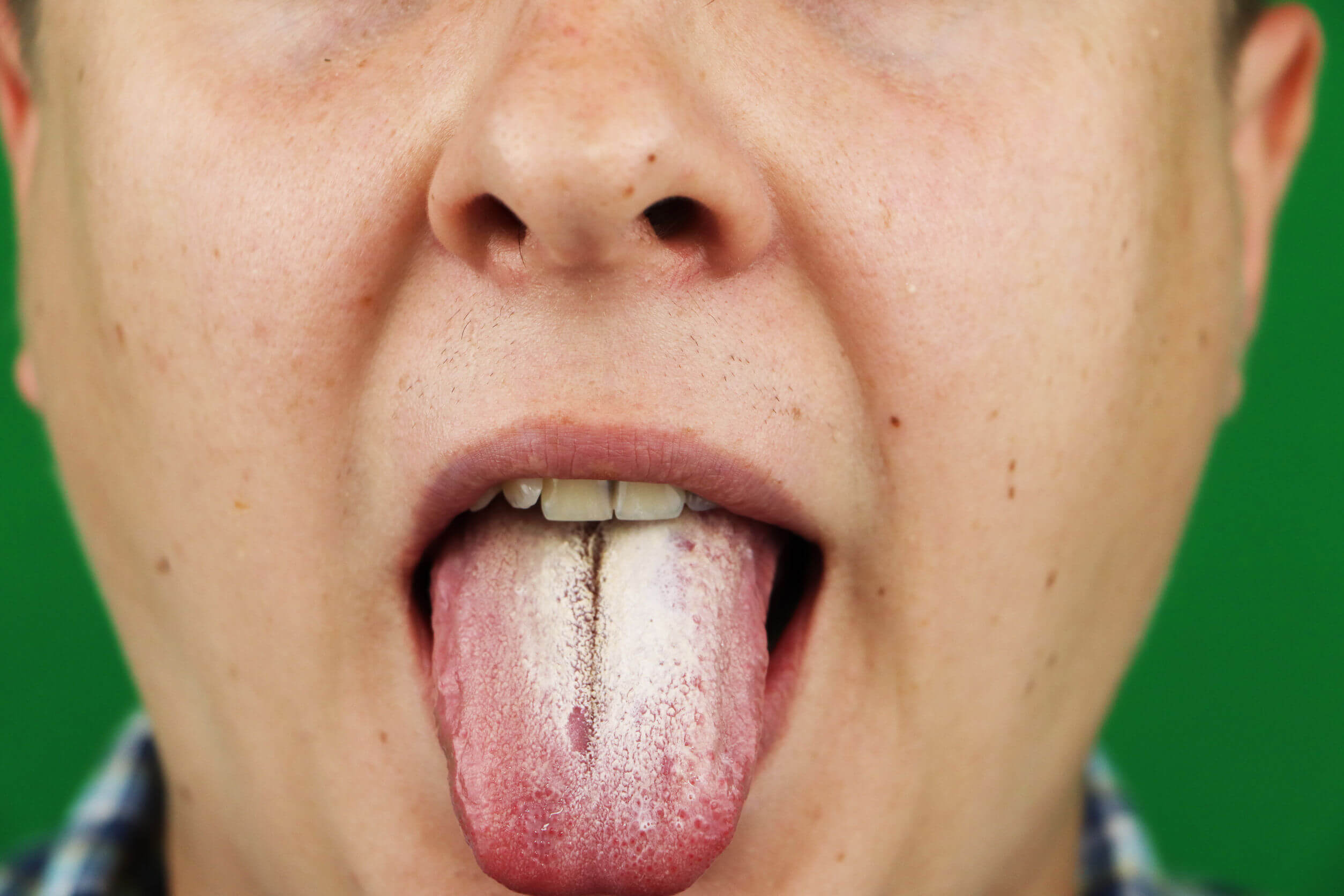 Candidiasis on the tongue.