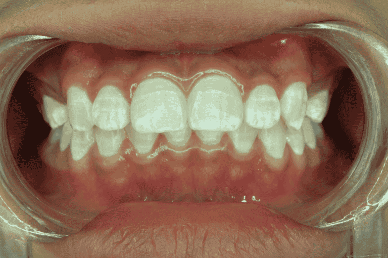 Manchas blancas en los dientes: ¿por qué aparecen?