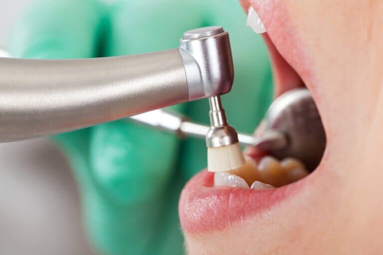 Limpieza dental: ¿cada cuánto se debe realizar?
