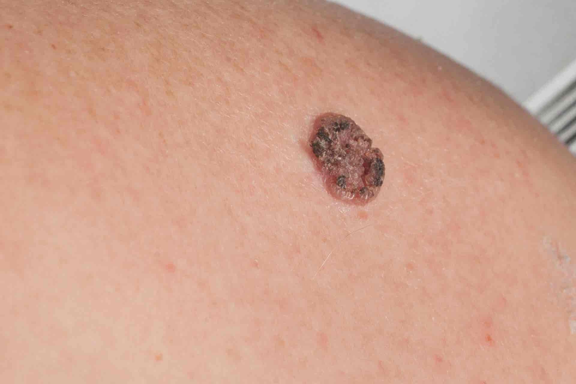 El carcinoma de células escamosas es una enfermedad de la piel