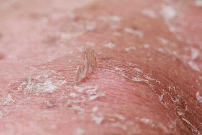 ¿Qué es la dermatitis exfoliativa generalizada y qué la causa?