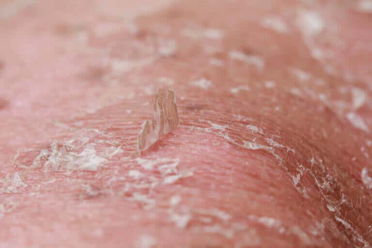 ¿Qué es la dermatitis exfoliativa generalizada y qué la causa?