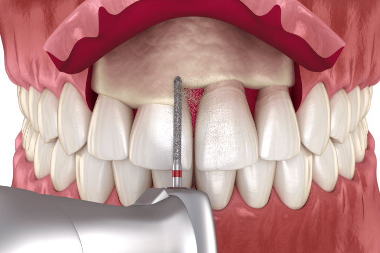¿Qué es una gingivectomía estética?
