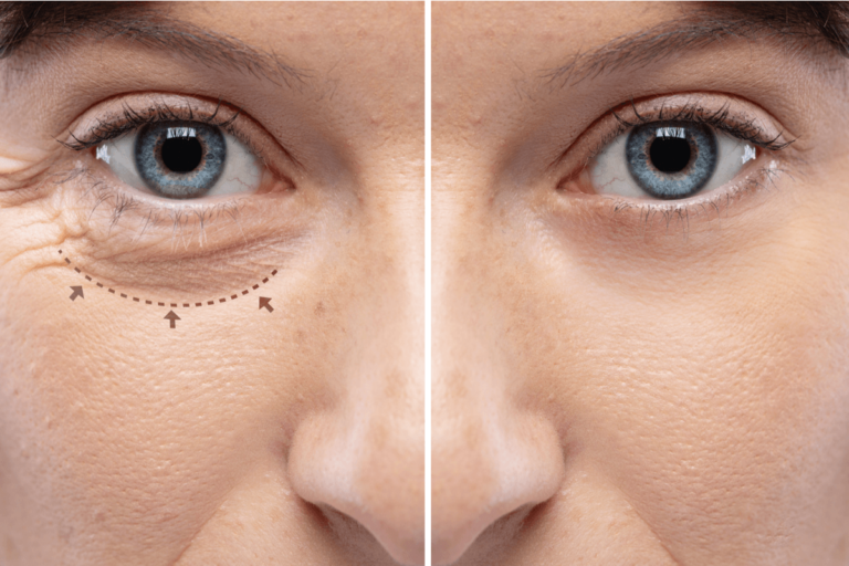 Blefaroplastia: en qué consiste, tipos y cuidados