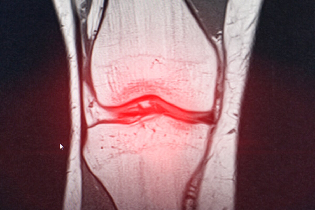 Überkopfkniebeuge - Röntgenbild eines Kniegelenks