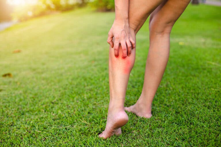 10 consejos para cuidar la piel con urticaria crónica en verano