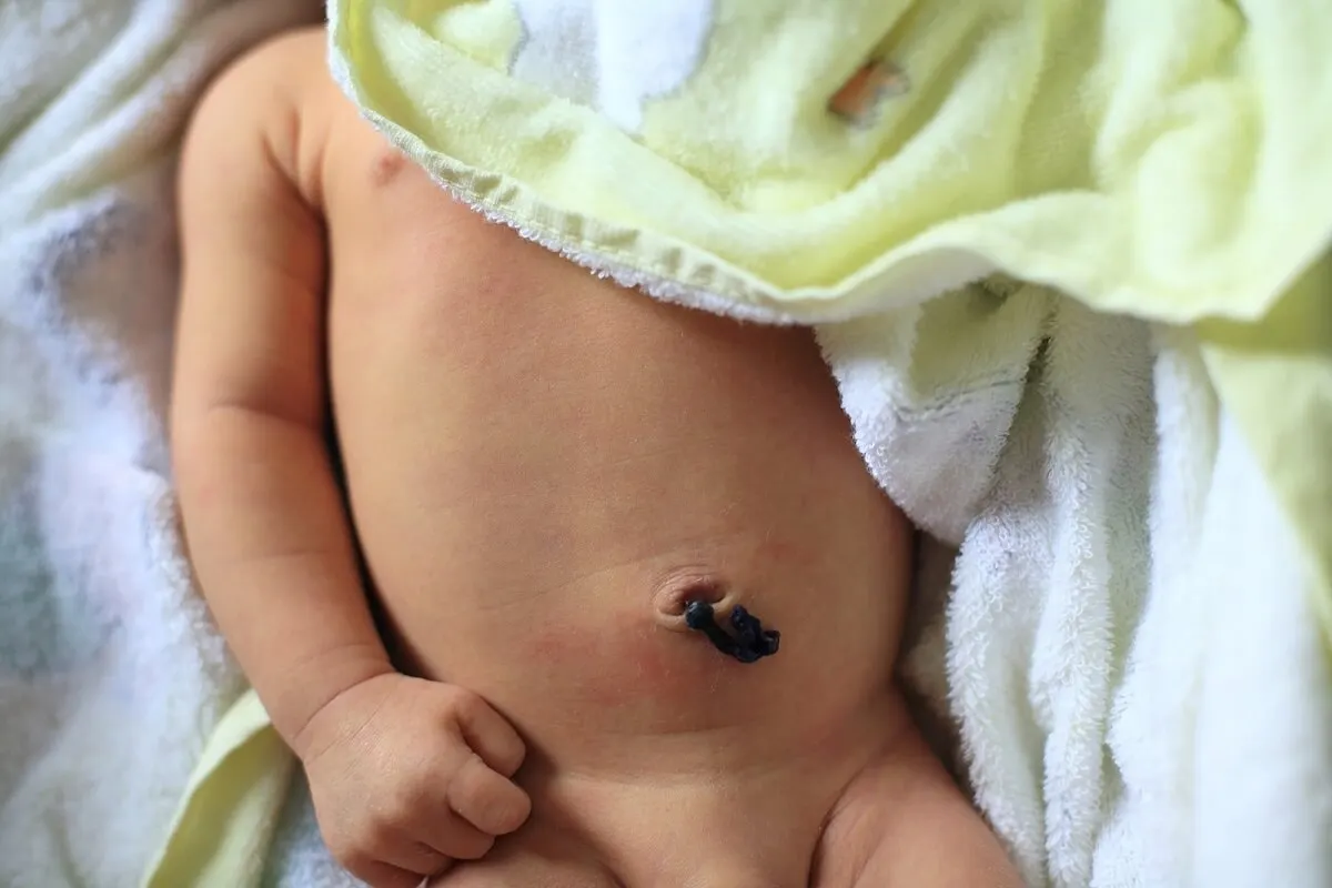 ¿Qué es un granuloma umbilical?