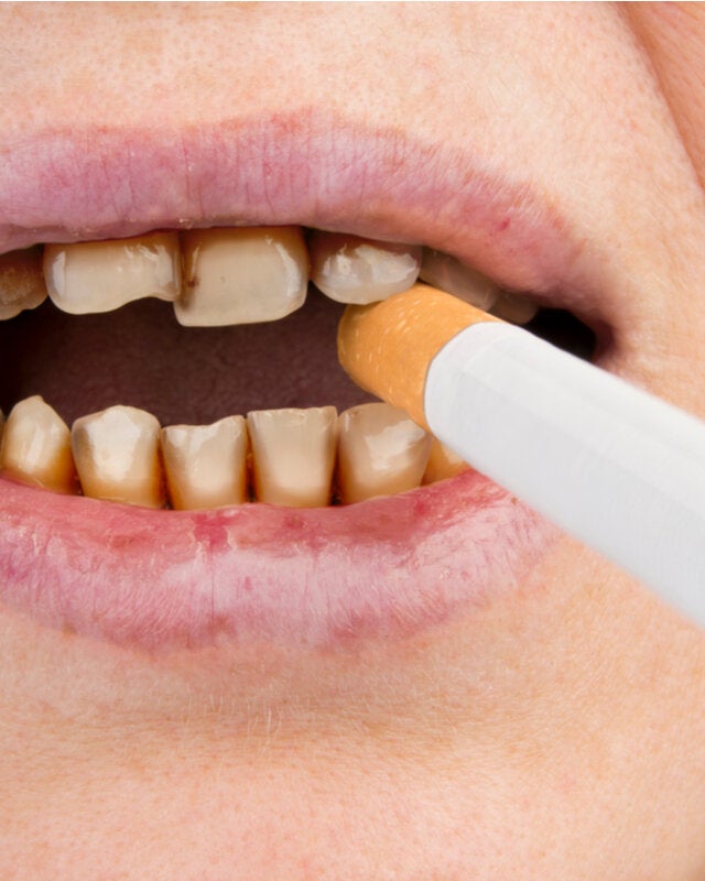 té halcón Diversidad Cómo afecta el tabaco la salud de los dientes? - Mejor con Salud