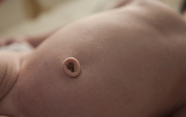Granuloma umbilical: qué es y cómo es su tratamiento