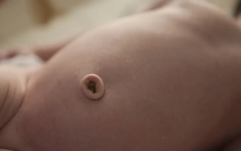 Granuloma umbilical: qué es y cómo es su tratamiento
