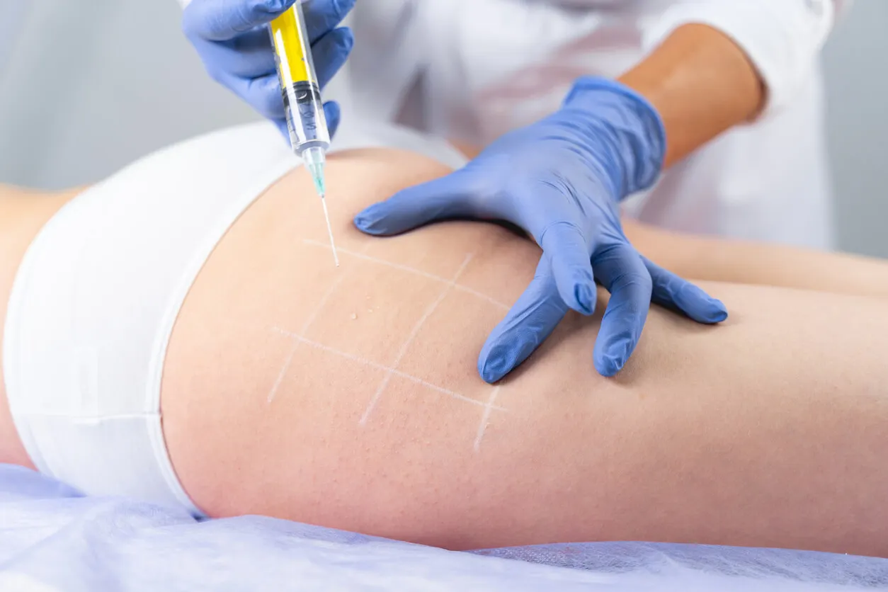 Handverjüngung - Liposuktion und Lipofilling