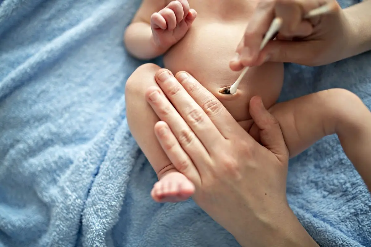 Tratamiento del granuloma umbilical