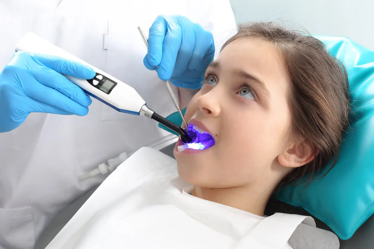 Selladores dentales en una niña.